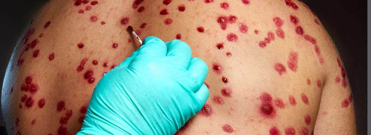 Monkeypox: Prevention and Clinical Features for Travelers